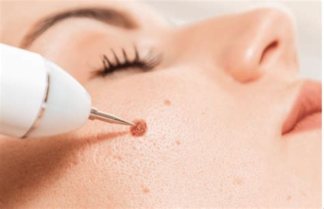 laser mole removal dermatologist