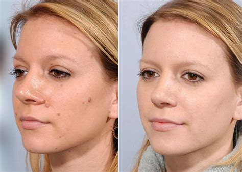 laser mole removal recovery
