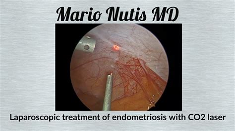 laser of endometriosis cpt
