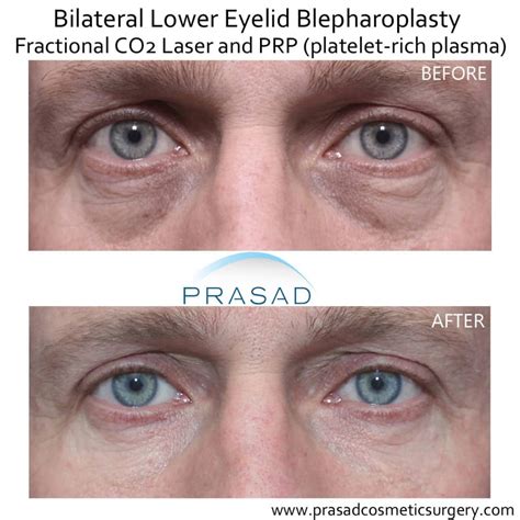 laser surgery for dark circles under eyes