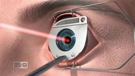 laser surgery for eyes side effects