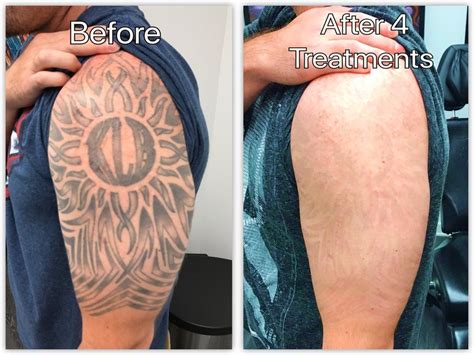 laser tattoo removal aftermath