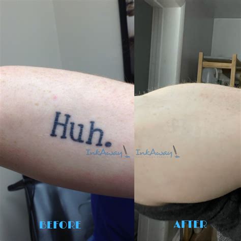 laser tattoo removal cleveland tennessee