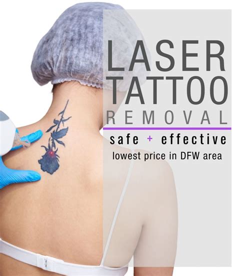 laser tattoo removal dallas tx