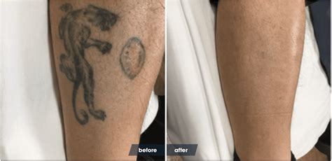laser tattoo removal healing pictures