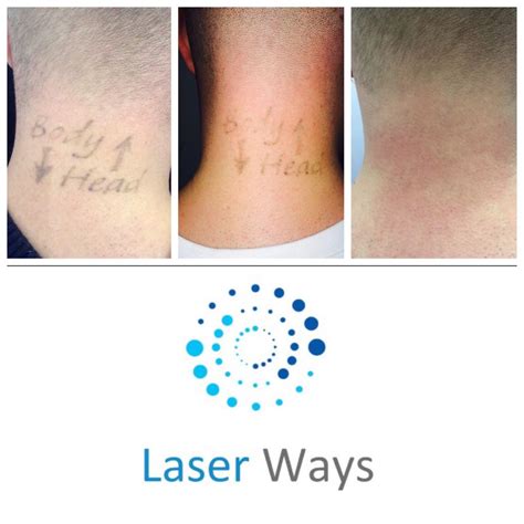 laser tattoo removal newcastle
