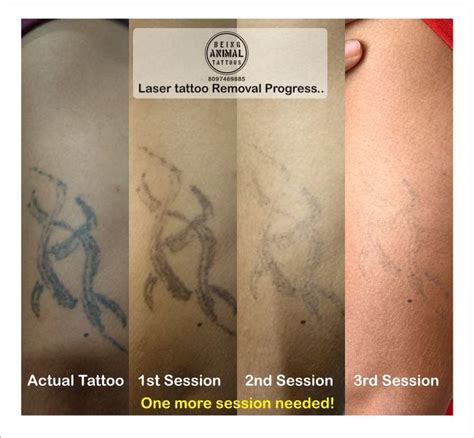 laser tattoo removal scottsdale az