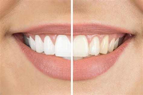 laser teeth whitening austin tx