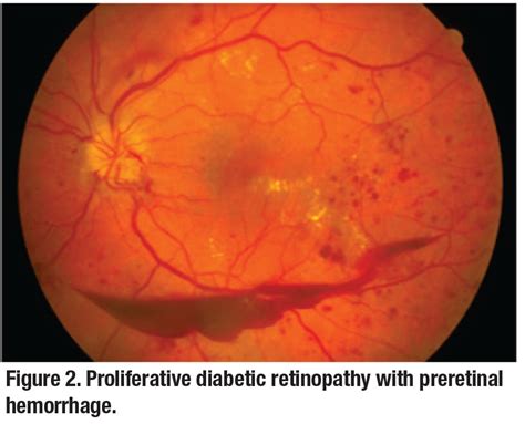 laser treatment for diabetic eye bleeding