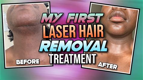 laser treatment for facial hair removal cost