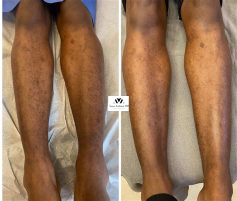 laser treatment for legs near me reviews