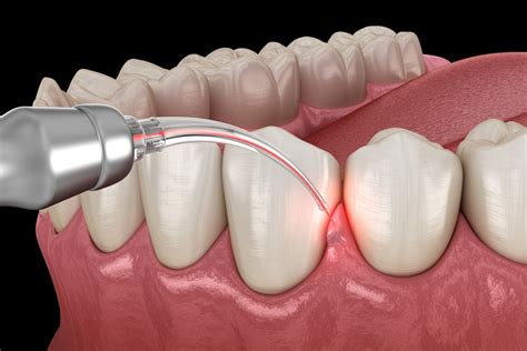 laser treatment for periodontal disease