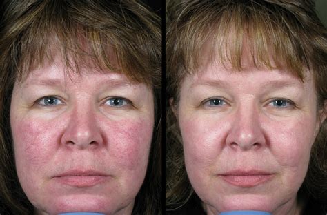 Before & After Photos Vascular Lasers for Redness & Veins Cosmetic