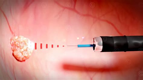 Laser Treatment For Weak Bladder