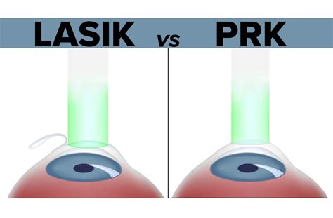 laser vs lasik difference
