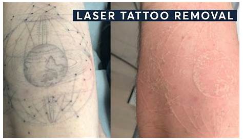 Laseraway Tattoo Removal Before And After 13 Facts To Know