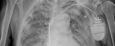 Lasers And Pacemakers