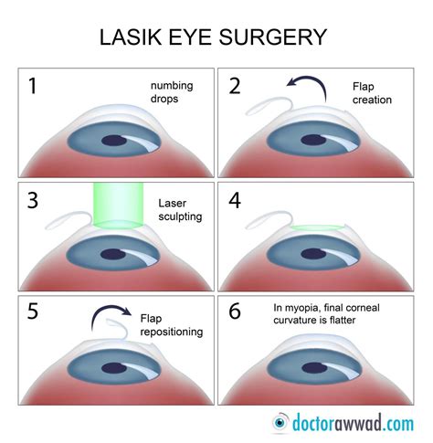 lasik eye surgery instructions