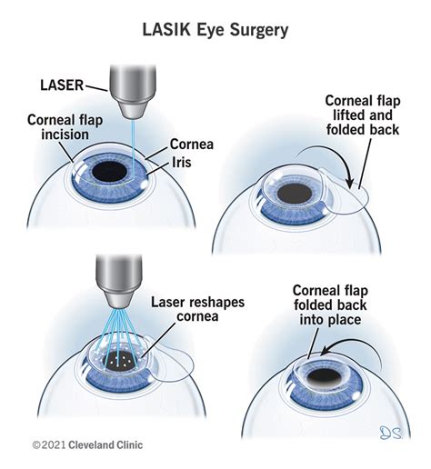 lasik eye surgery or non lasik