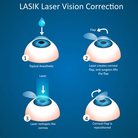 lasik laser vision correction approaches