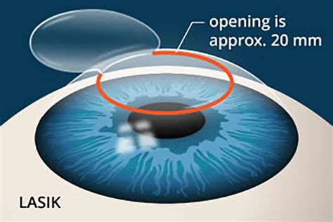 lasik surgery faq