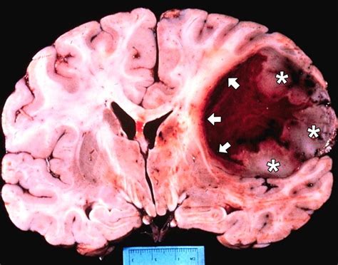 last stages of glioblastoma brain tumor