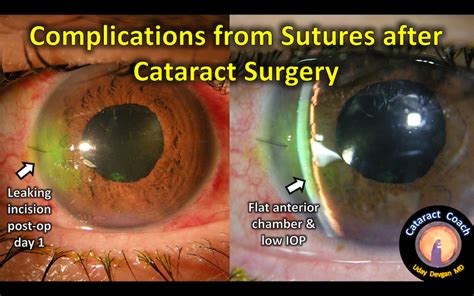 late complications of cataract surgery