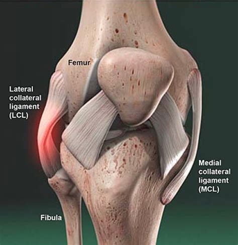 Understanding the Lateral Collateral Ligament: Causes, Symptoms, and Treatment Options for Knee Stability