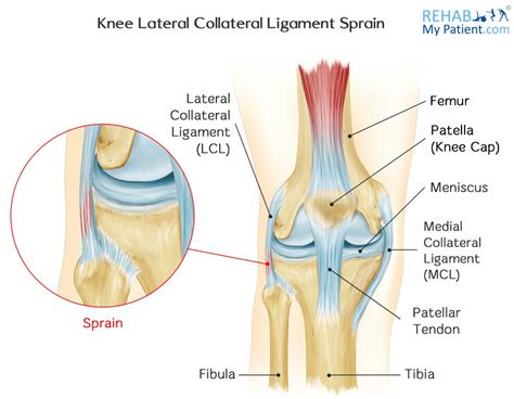Understanding Lateral Collateral Ligament Sprain: Causes and Treatments