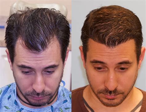 Hair Restoration Photos Melbourne, FL Patient 16955