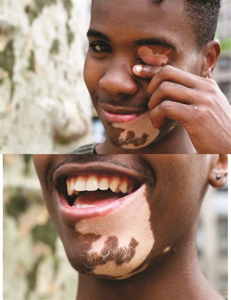 latest news on vitiligo