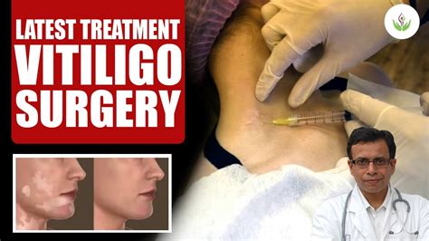 latest news on vitiligo treatment