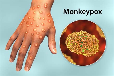 latest on monkeypox virus today
