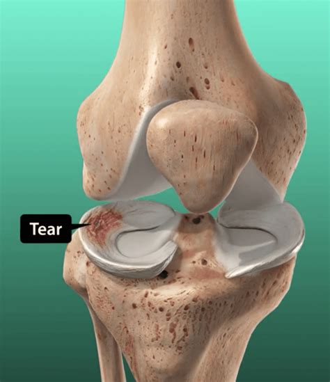 latest treatment for knee cartilage