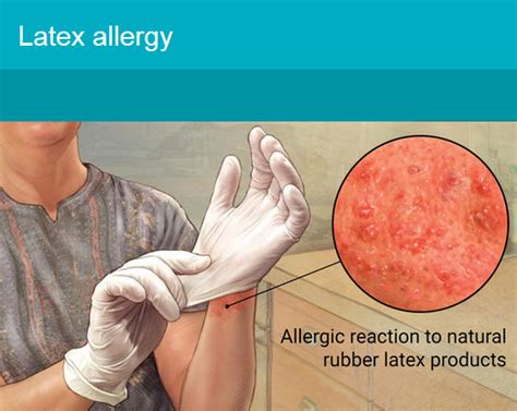 Latex Gloves Allergy Test