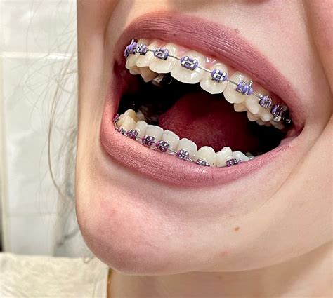 Lavender Braces
