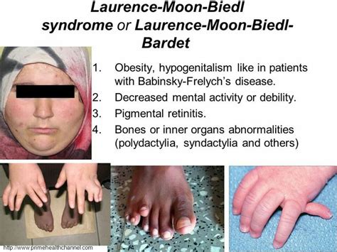 lawrence moon biedl syndrome symptoms