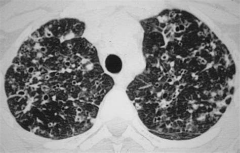 lch pulmonary