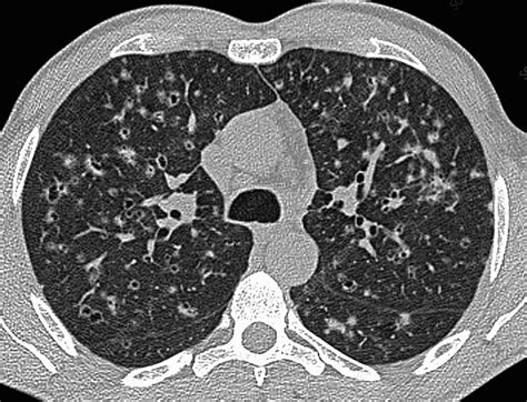 lch pulmonary radiology