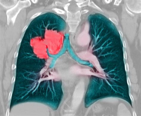 ld ct lung cancer screening