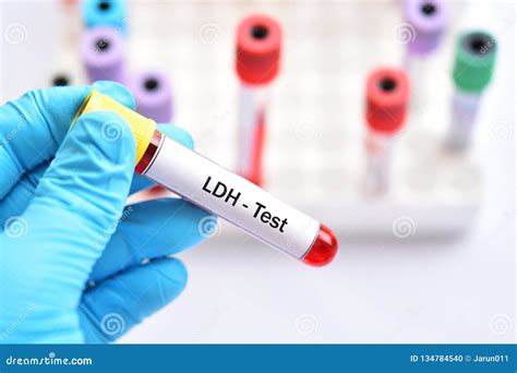 Understanding LDH Blood Test: What Do Results Indicate?