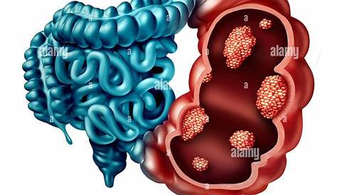 Cancer de l'intestin ou du côlon la différence