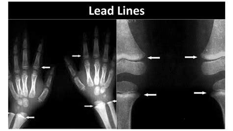 Lead X-Ray Lines