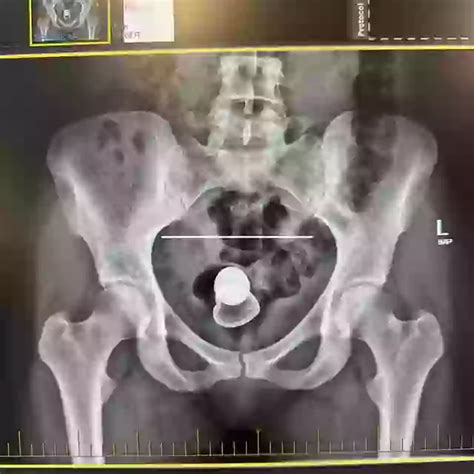 leaked xray onlyfans