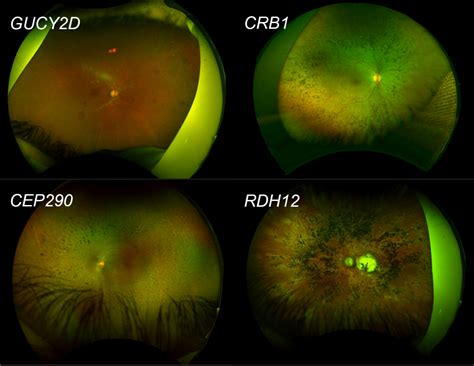 Leber Congenital Amaurosis Inheritance Pattern
