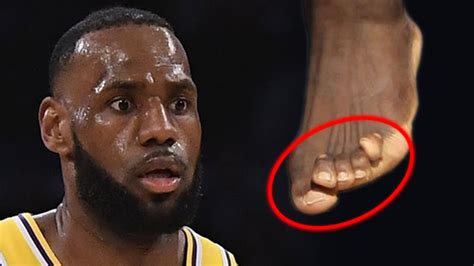 lebron's feet are deformed