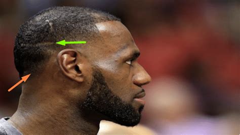 lebron james hair transplant scar