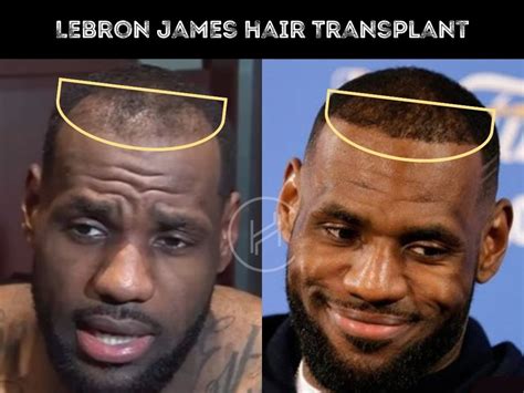 lebron james with hair