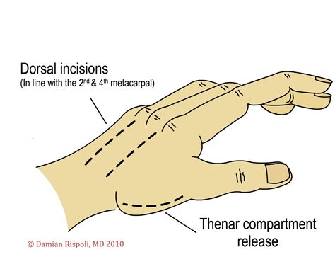 Left 1St Dorsal Compartment Release Cpt Code