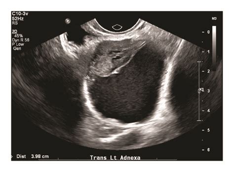 left adnexal mass